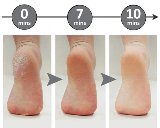 Electric Foot File Callus Remover